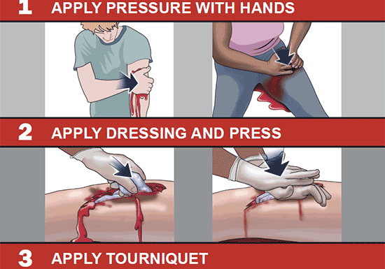 A poster showing how to use a bleeding control device.